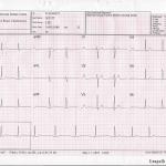 lee ecg 110507