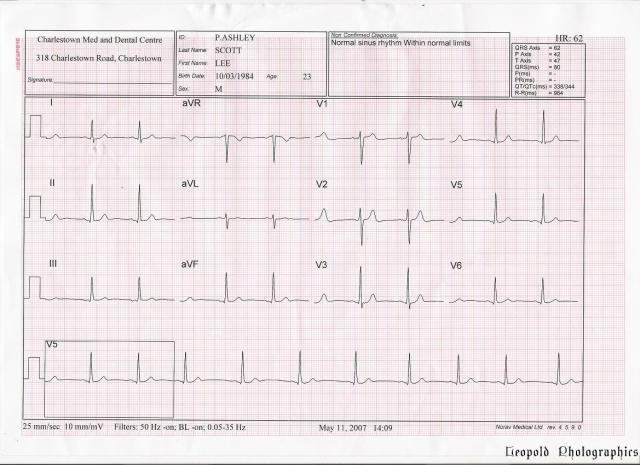 lee ecg 110507