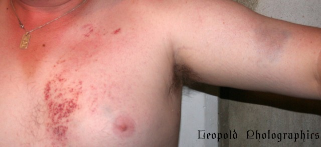 24hrs after accident