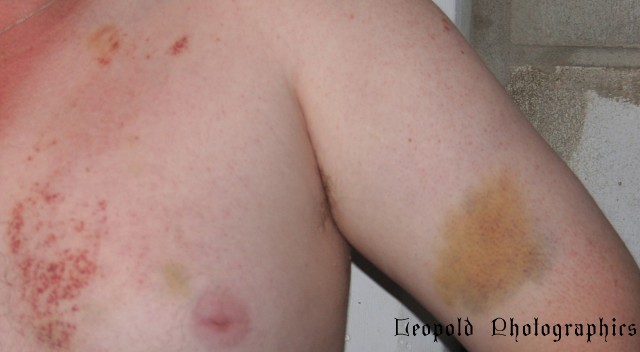 100hrs after accident